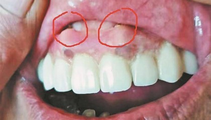 绥化刘先生反映其母亲种牙后,牙龈鼓俩大包,顶嘴唇!哈尔滨市优诺口腔回应